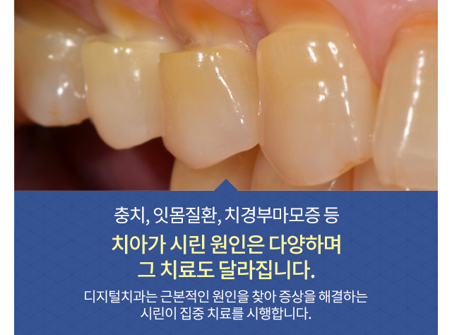 충치, 잇몸질환, 치경부마모증 등 치아가 시린 원인은 다양하며 그 치료도 달라집니다. 디지털치과는 근본적인 원인을 찾아 증상을 해결하는 시린이 집중 치료를 시행합니다.